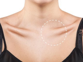 Real image featuring the sternoclavicular joint in a female.