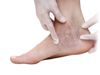Image illustrating varicose veins in the foot.